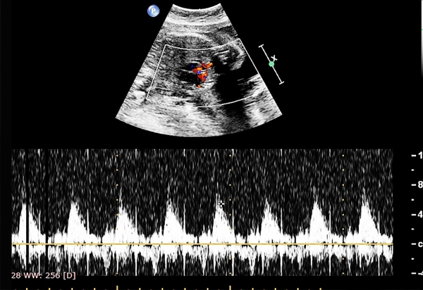 Fetal Echocardiography